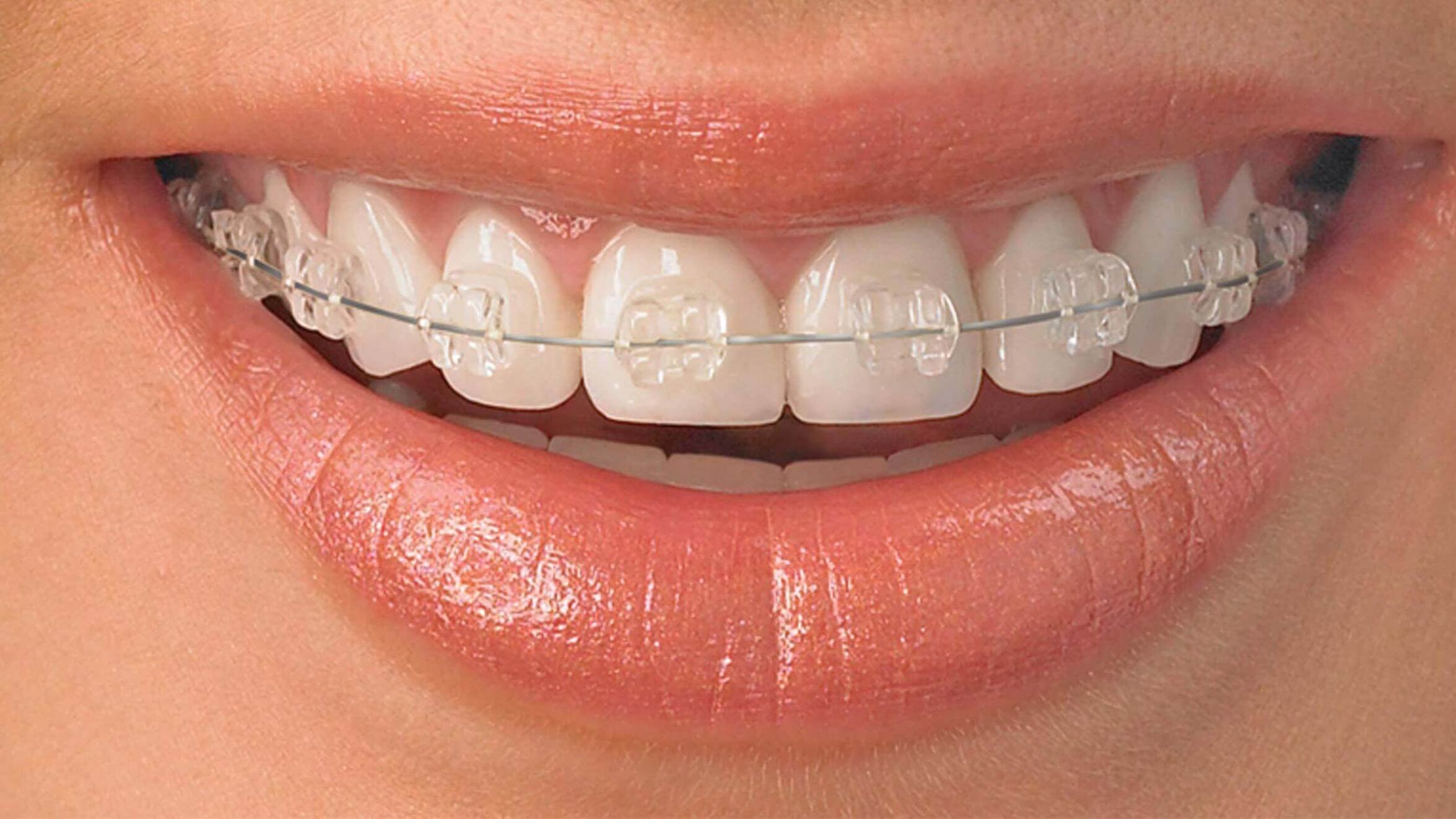 Brackets