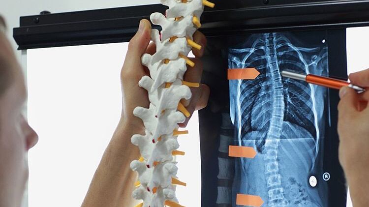 Escoliosis