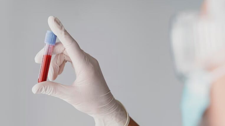 Prueba de sangre para detectar el alzhéimer