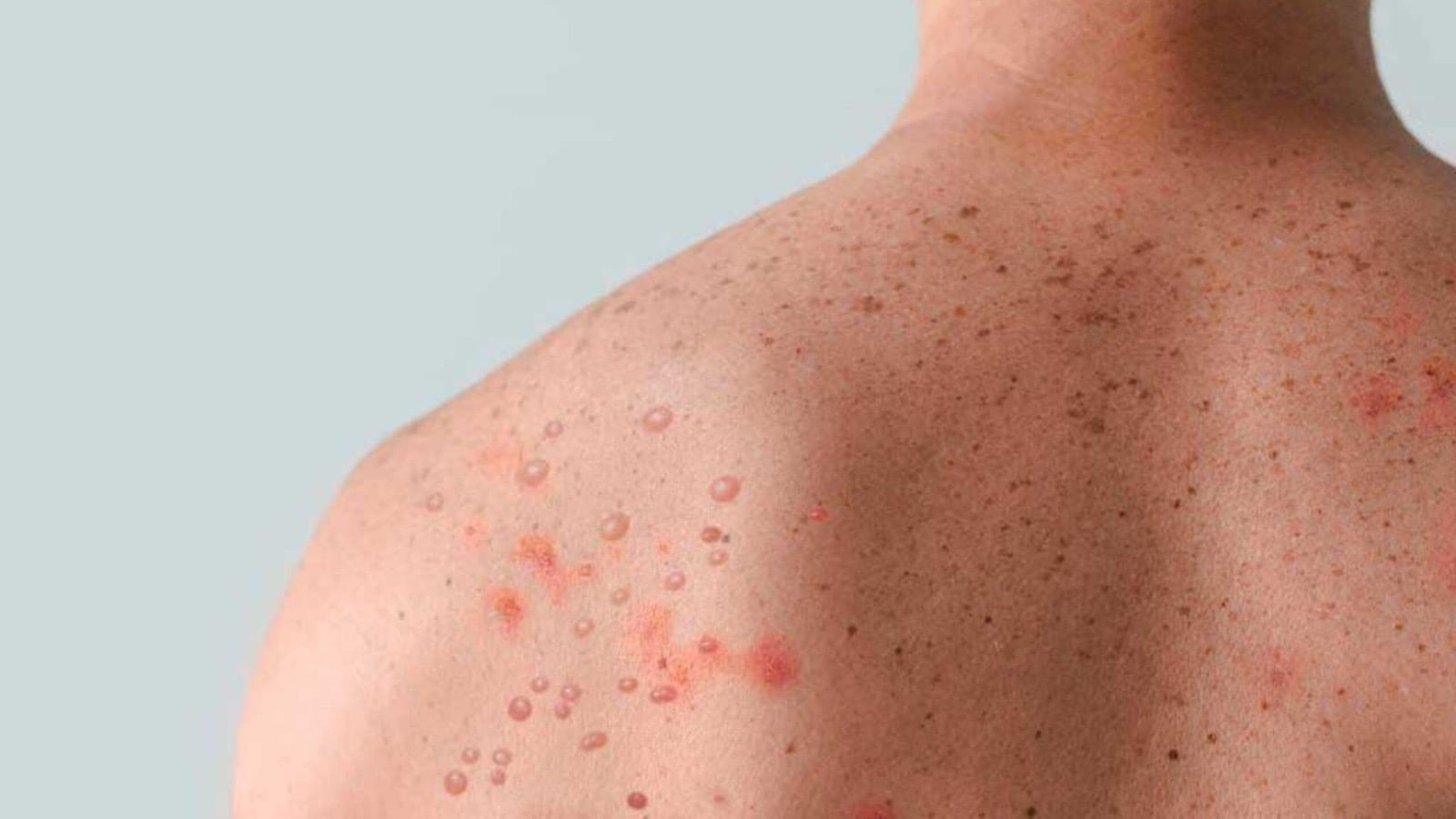 Querétaro registró un nuevo caso de sarampión