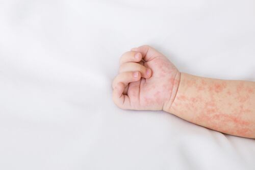 OMS afirmó que es “muy preocupante” el aumento de sarampión en 2023