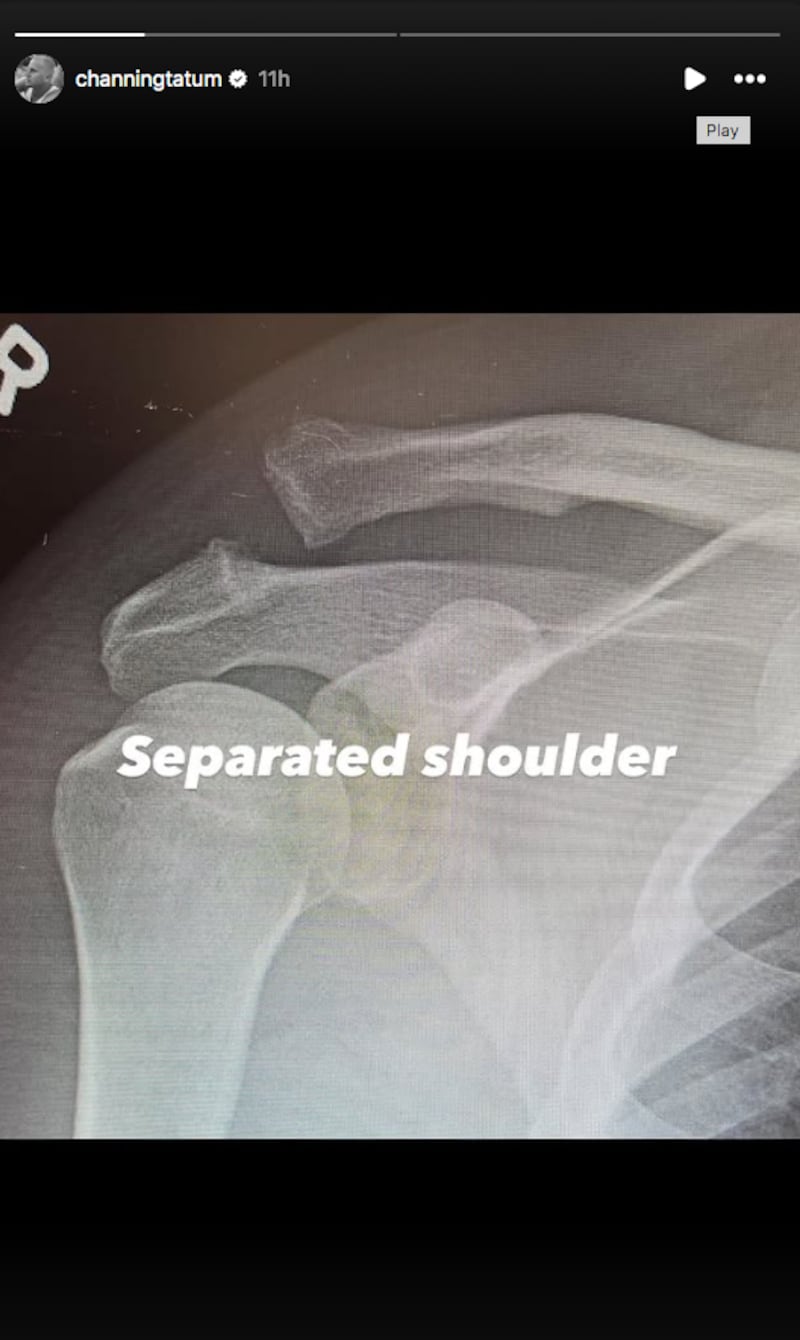 Lesión de Channing Tatum