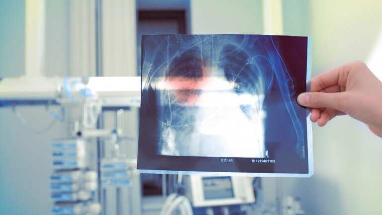 El polvo acumulado en los pulmones producto de trabajar en construcciones genera silicosis