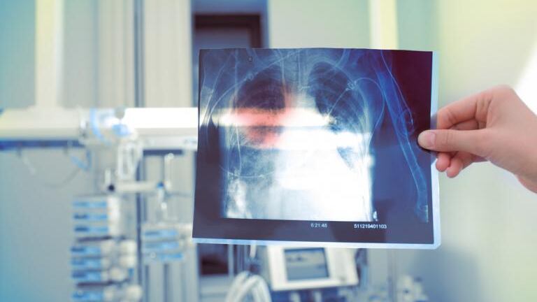 El polvo acumulado en los pulmones producto de trabajar en construcciones genera silicosis