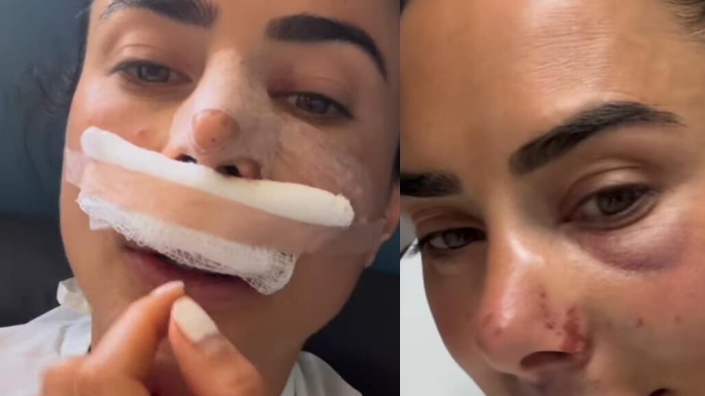 Johanna Fadul tuvo delicado accidente en medio de reality “se me salió un disco de la columna”