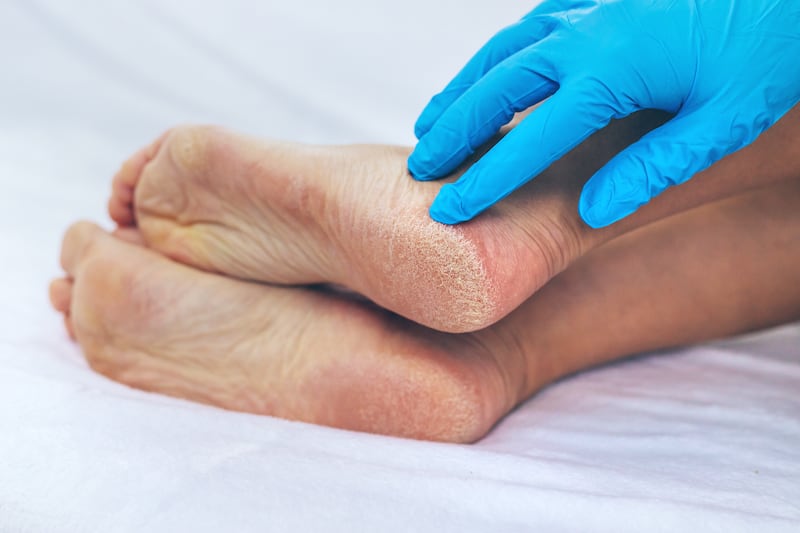 callos en los pies