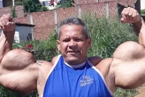 Fallece el “Popeye brasileño”: hombre que se inyectaba aceite mineral para aumentar sus músculos