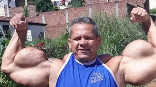 Fallece hombre que se inyectaba aceite mineral en los brazos, conocido como el Popeye Brasilero - Fuente: Foto de X