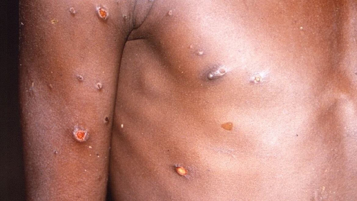 La presencia de lesiones en la piel es el primer indicativo de la enfermedad.