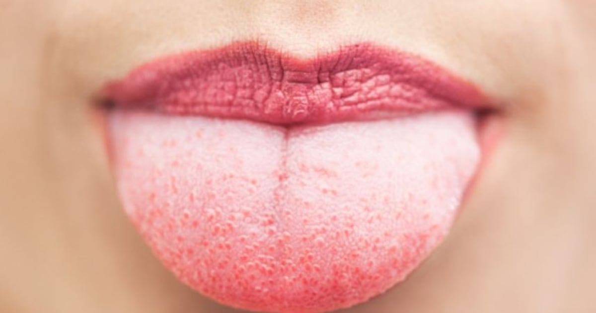 ¿Qué secreta tu lengua sobre tu salud? Descubre los signos reveladores