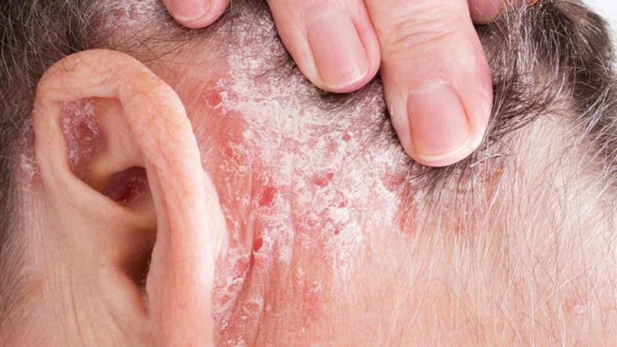 Psoriasis Pustulosa Generalizada