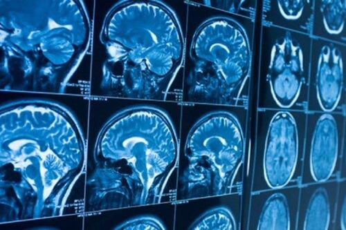Estudio identifica deficiencia de litio como posible causa temprana del Alzheimer