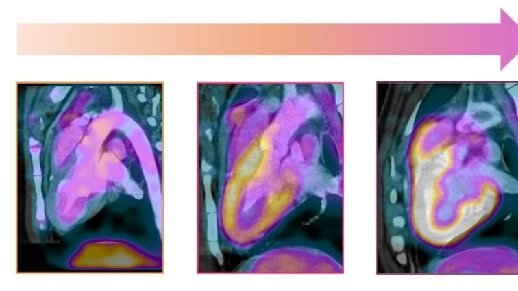 Imágenes del corazón que permiten visualizar su metabolismo. El color amarillo indica mayor alteración en el uso de la energía por el músculo cardíaco. De izquierda a derecha: corazón sano, cambios metabólicos tempranos sin síntomas y alteraciones asociadas a una disfunción cardíaca. Imagen cedida por el Centro Nacional de Investigaciones Cardiovasculares.