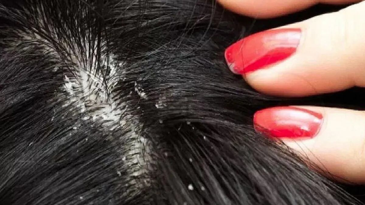 Para prevenir la caspa se debe mantener el cabello limpio y sano.