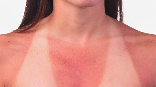 Medidas si te quemaste por el sol en tu feriado