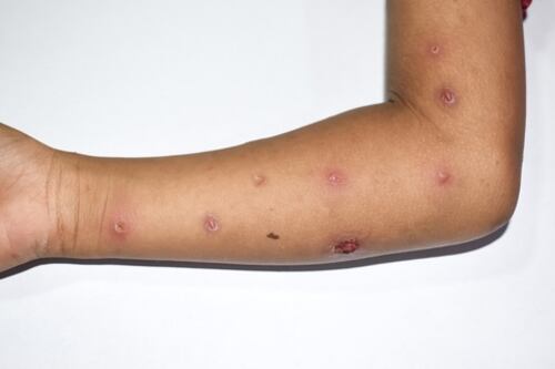 Argentina confirmó su tercer caso de la Viruela del Mono