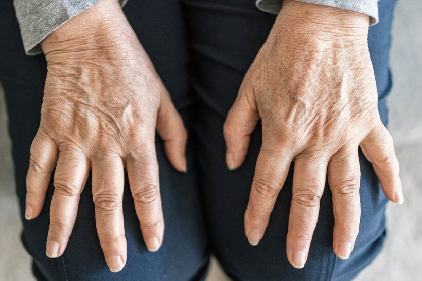 La osteoporosis es una enfermedad que hace que los huesos se debiliten y se vuelvan frágiles, en tal medida que una caída o hasta una leve tensión, como agacharse o toser, pueden causar una fractura. Foto: SPED.