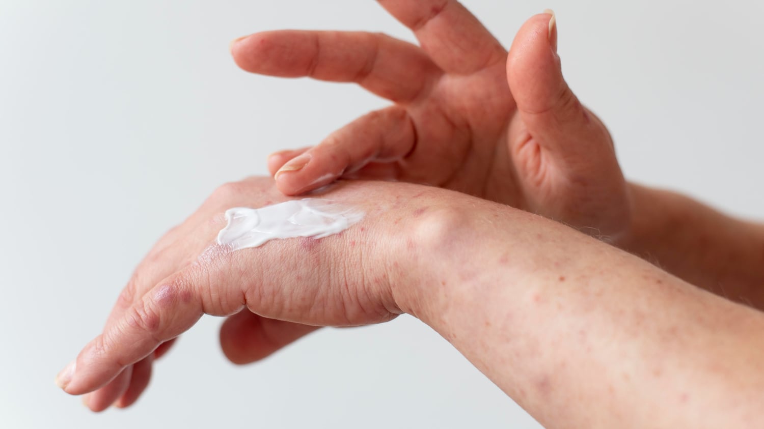 A través de la innovación en productos rehidratantes y diversas acciones sociales se buscan generar nuevos tratamientos disponibles