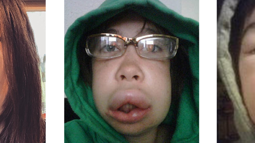 Angioedema Hereditario