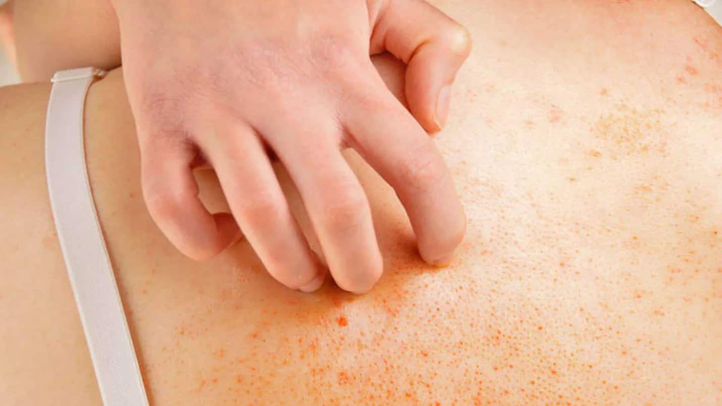 La dermatitis atópica es una enfermedad crónica de la piel.