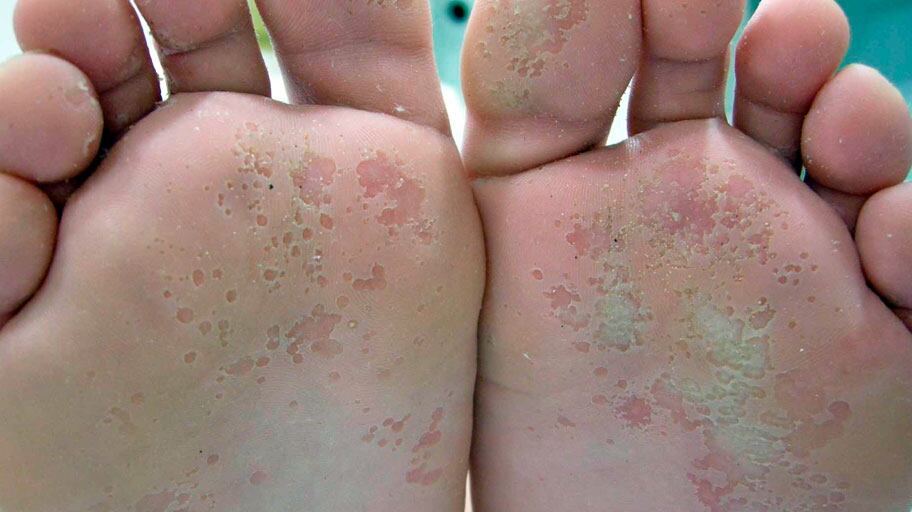 El pie de atleta es una infección fúngica en la piel que, por lo general, comienza entre los dedos de los pies. Foto: Fundación Mexicana de Dermatología.