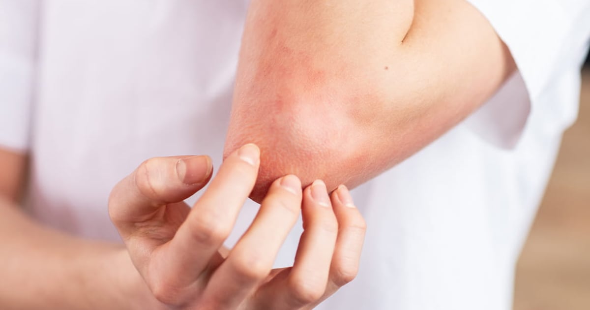 Psoriasis: La lucha diaria por acceder a servicios de salud y mejorar la calidad de vida