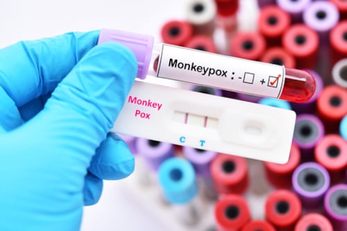 Alerta: OMS declara que la viruela del mono es una emergencia de salud pública